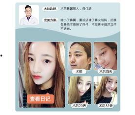 网红鼻修复自然,自然之美，重塑自然风韵